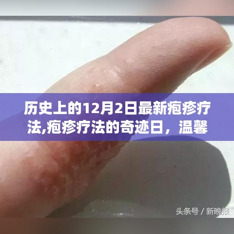 皰疹療法的奇跡日，友情與愛在歷史上的溫馨故事
