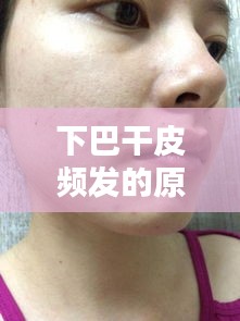 下巴干皮頻發(fā)的原因、對策及日常護理之道