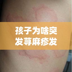 孩子為啥突發(fā)蕁麻疹發(fā)燒：小孩蕁麻疹又發(fā)燒怎么辦 