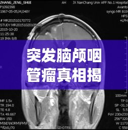 突發(fā)腦顱咽管瘤真相揭秘，探究疾病背后的秘密
