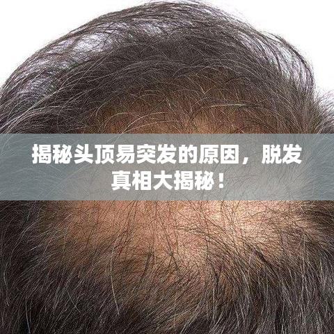 揭秘頭頂易突發的原因，脫發真相大揭秘！